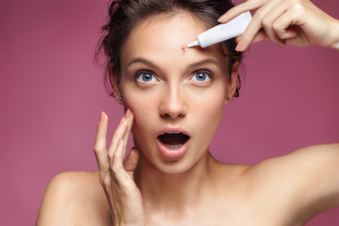 Jerawat Bisa Tunjukkan Kondisi Tubuh Kita? Coba Pahami Dulu Yuk